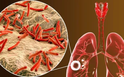 OMS: Tuberculosis vuelve a ser la mayor causa infecciosa de muerte