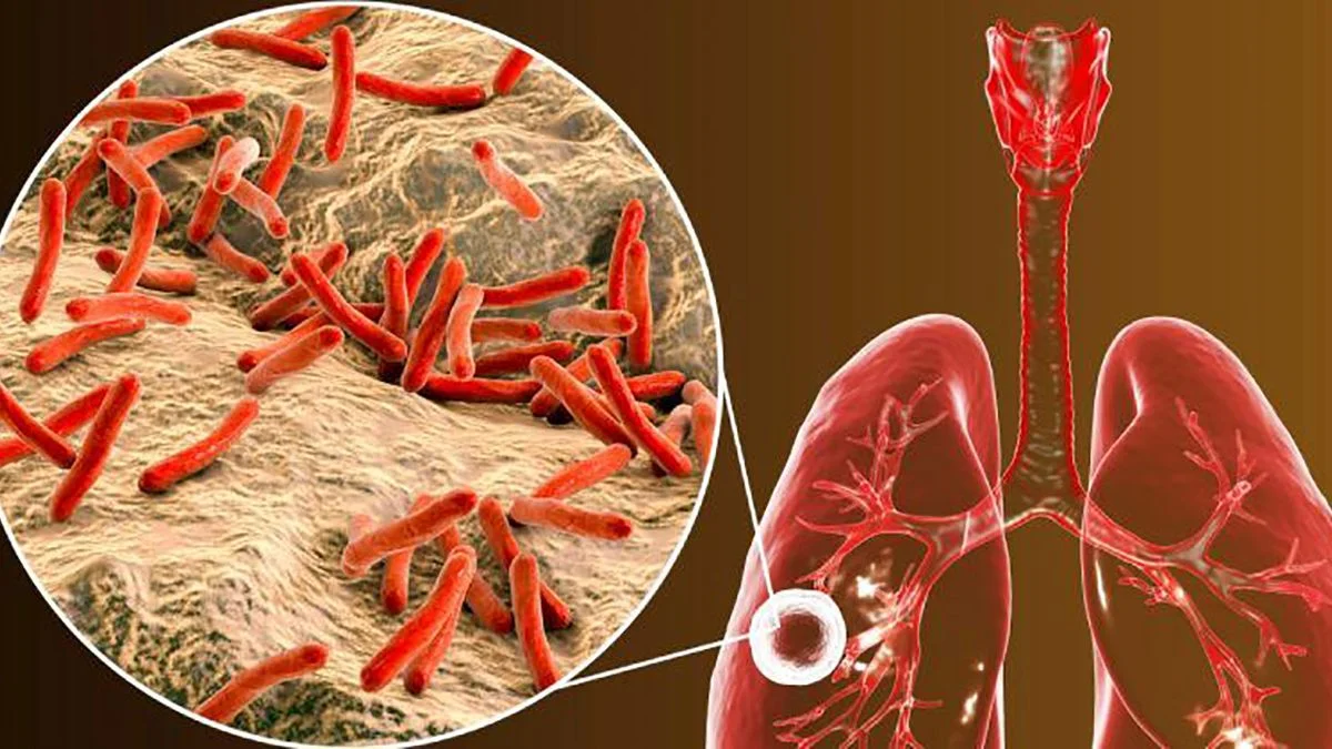 OMS: Tuberculosis vuelve a ser la mayor causa infecciosa de muerte