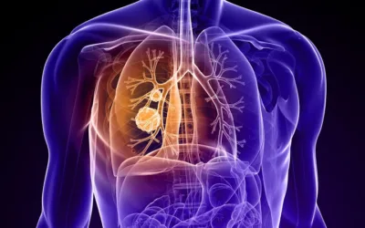 Sintomatología del cáncer de pulmón