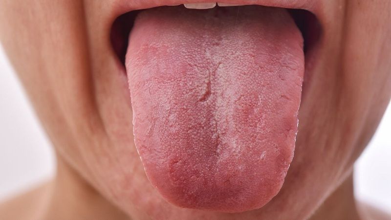 ¿Cuáles enfermedades causan fisuras en la lengua?