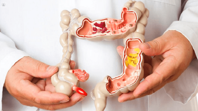 El síndrome del intestino irritable