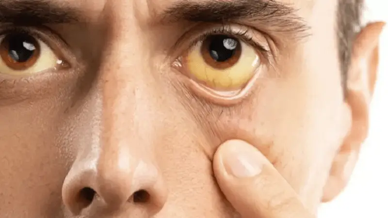 Lo que sus ojos pueden revelar de su salud