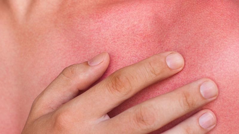 Recomendaciones para prevenir daños en la piel