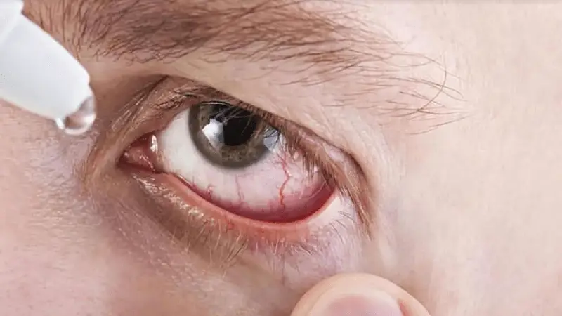 Lo que debe saber del síndrome del ojo seco