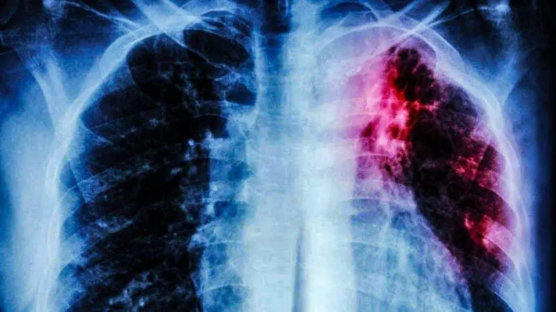 Colombia es el cuarto país de las Américas en casos de TB